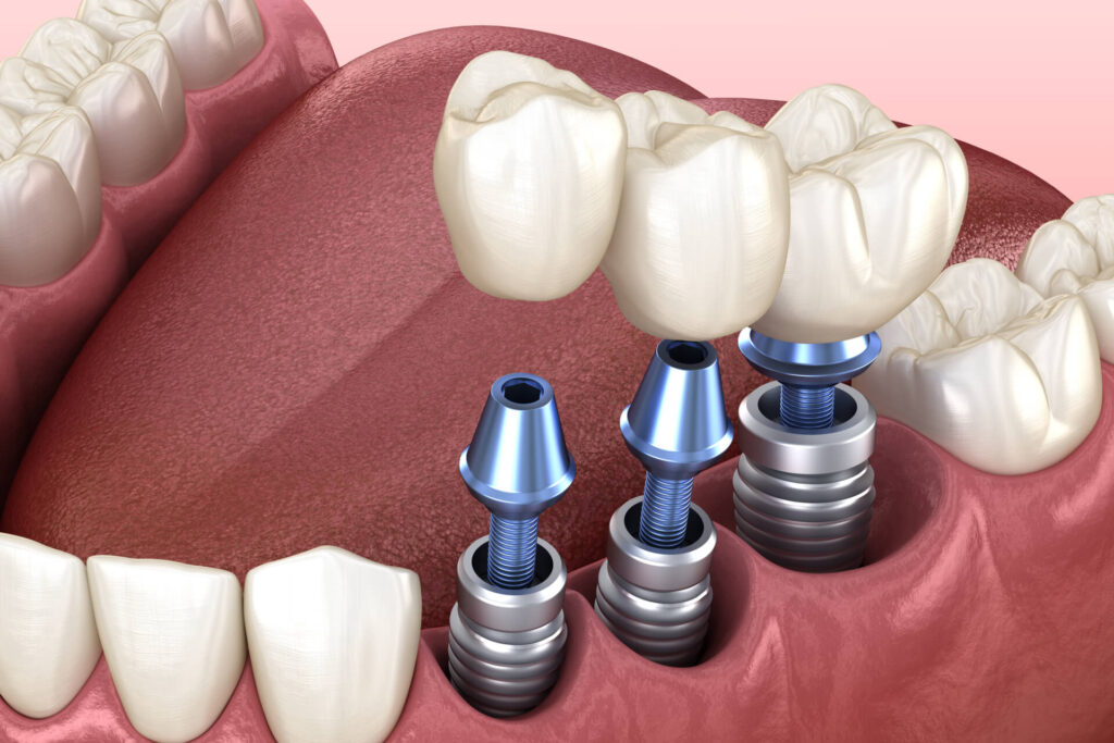3 tooth crowns placement over 3 implants - concept.