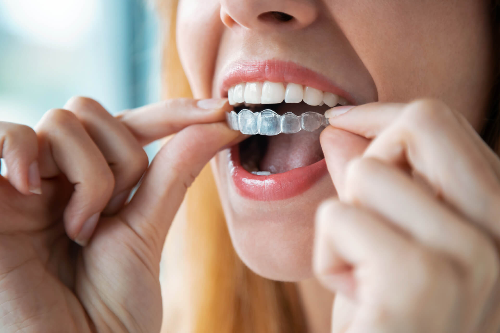 Invisalign, Clear Orthodontic Aligners and Six Month Braces Johns Creek